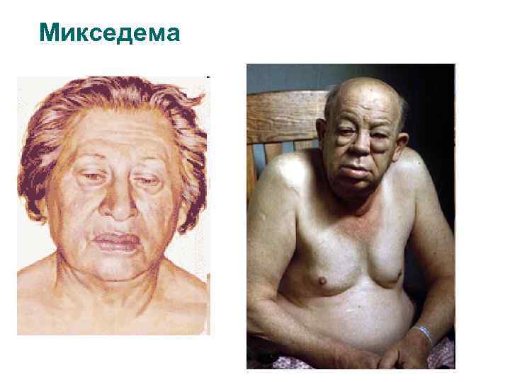 Микседема 