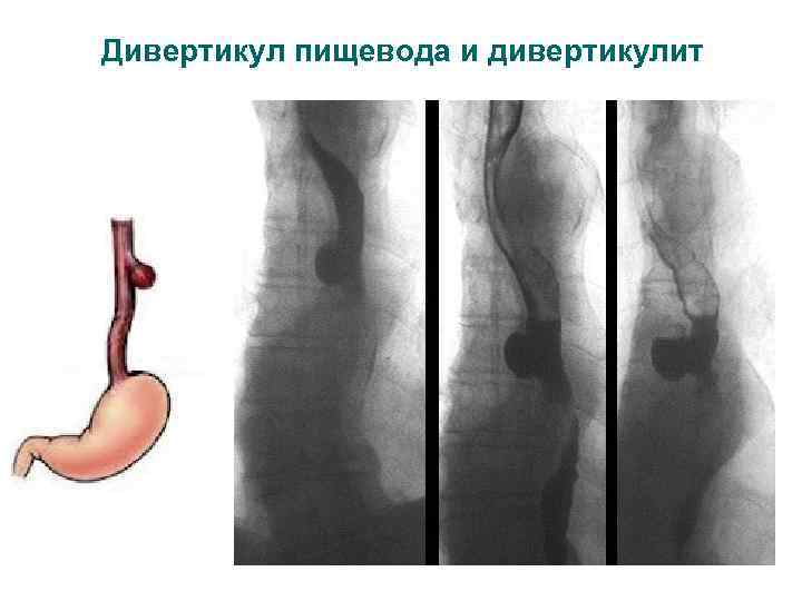 Дивертикул пищевода и дивертикулит 