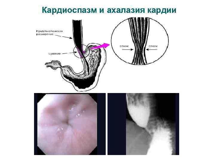 Кардиоспазм и ахалазия кардии 