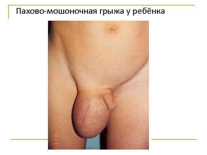 Пахово-мошоночная грыжа у ребёнка 