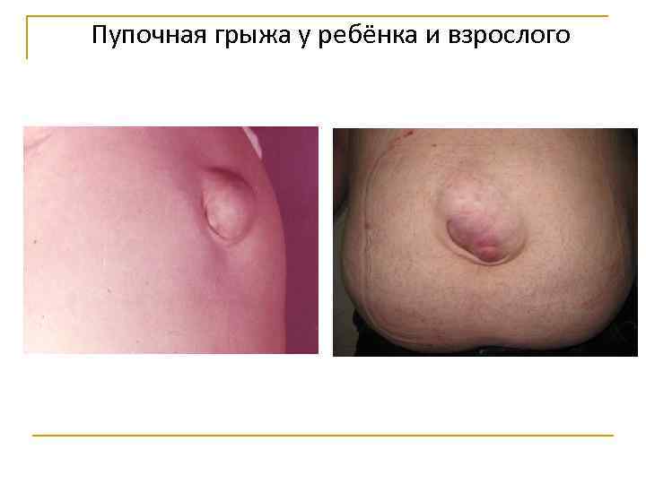 Пупочная грыжа у ребёнка и взрослого 