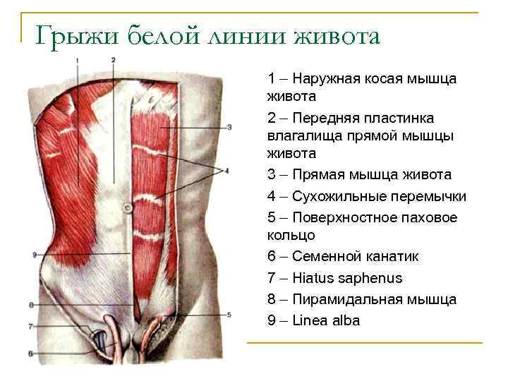 Грыжи белой линии живота 1 – Наружная косая мышца живота 2 – Передняя пластинка