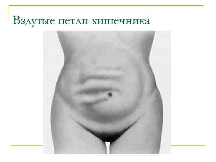 Вздутые петли кишечника 