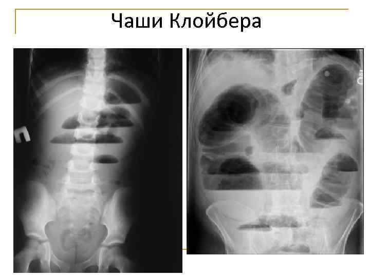 Чаши Клойбера 