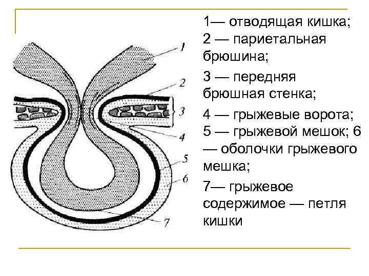 1— отводящая кишка; 2 — париетальная брюшина; 3 — передняя брюшная стенка; 4 —