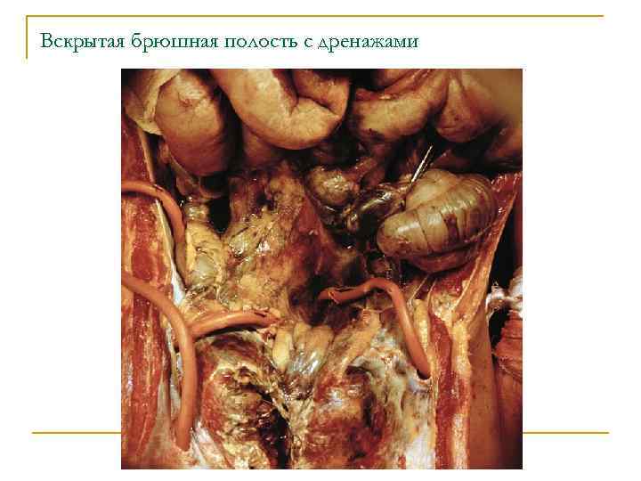 Вскрытая брюшная полость с дренажами 
