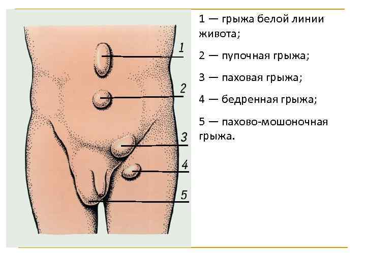 1 — грыжа белой линии живота; 2 — пупочная грыжа; 3 — паховая грыжа;