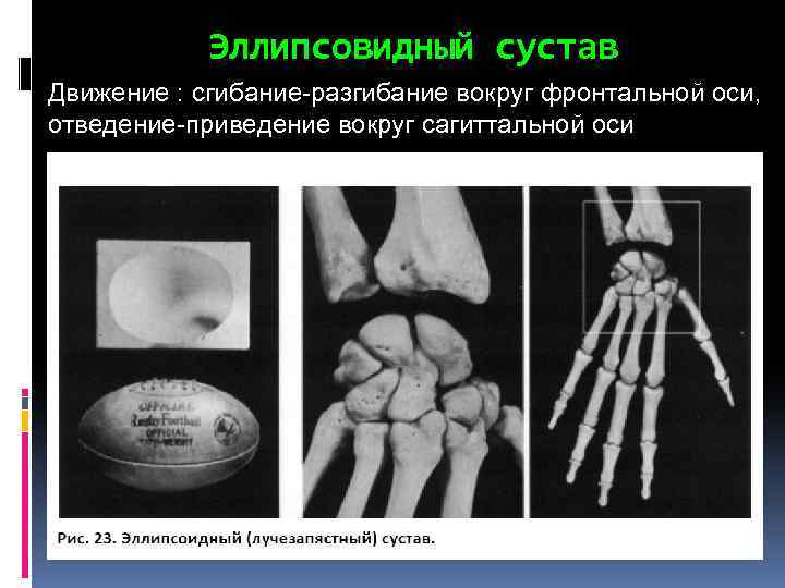 Эллипсовидный сустав Движение : сгибание-разгибание вокруг фронтальной оси, отведение-приведение вокруг сагиттальной оси 