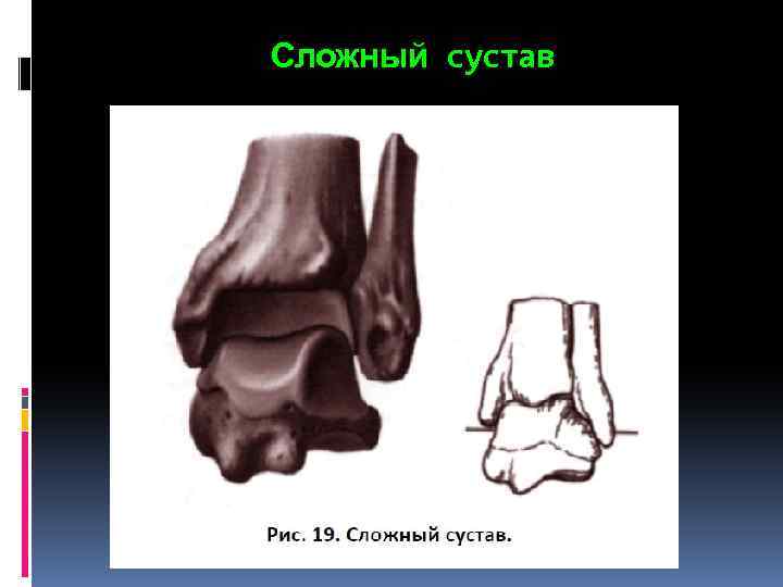 Сложный сустав 