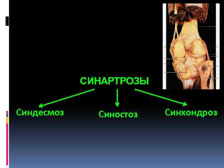 СИНАРТРОЗЫ Синдесмоз Синостоз Синхондроз 