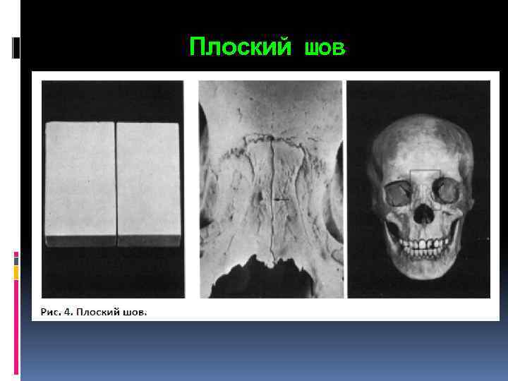 Плоский шов 