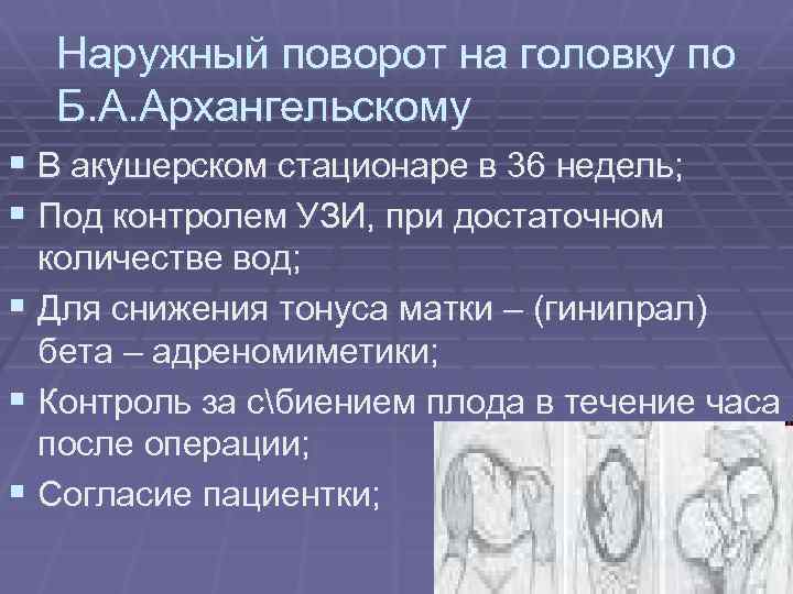 Наружный поворот на головку по Б. А. Архангельскому § В акушерском стационаре в 36