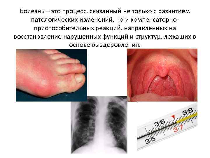 Болезнь – это процесс, связанный не только с развитием патологических изменений, но и компенсаторноприспособительных