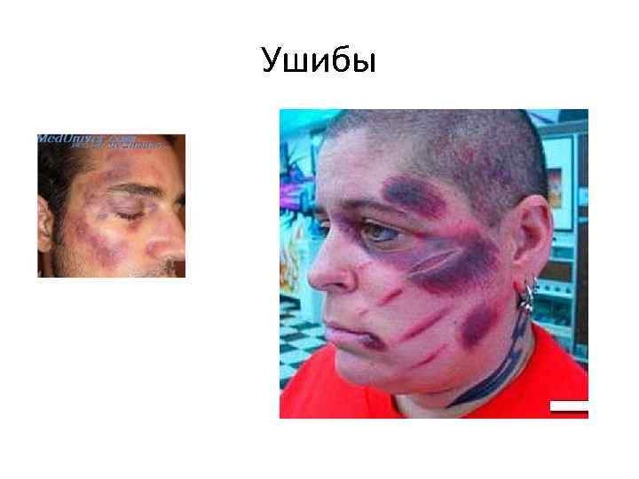 Ушибы 