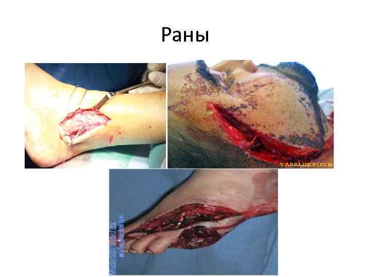 Раны 