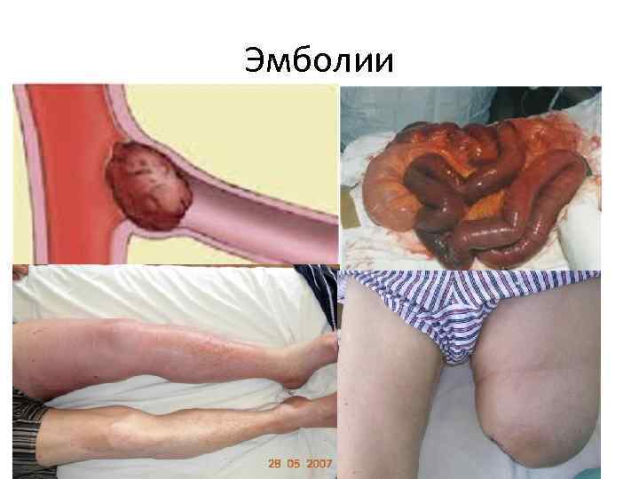 Эмболии 