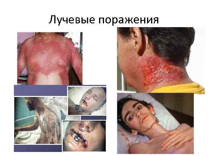 Лучевые поражения 