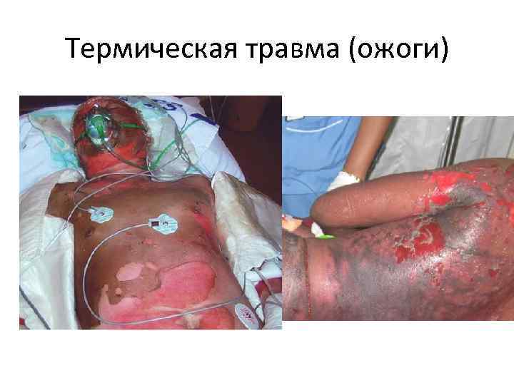 Термическая травма (ожоги) 