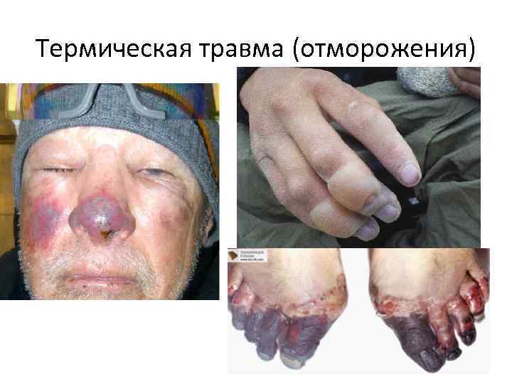 Термическая травма (отморожения) 
