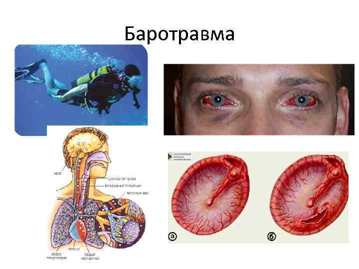 Баротравма 