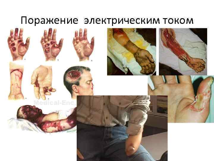 Поражение электрическим током 