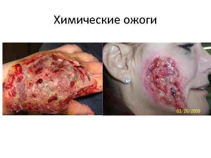 Химические ожоги 