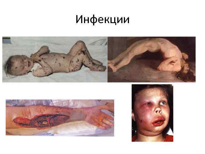 Инфекции 