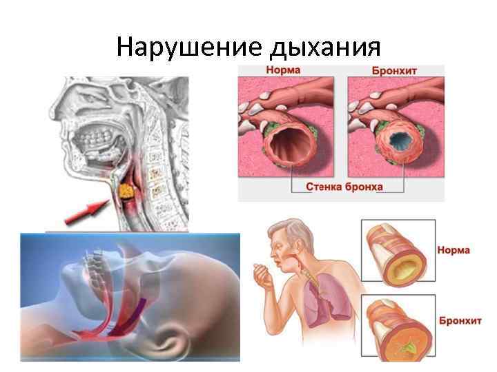 Нарушение дыхания 