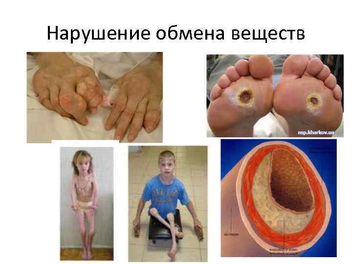 Нарушение обмена веществ 