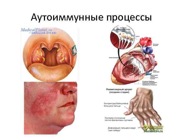 Аутоиммунные процессы 