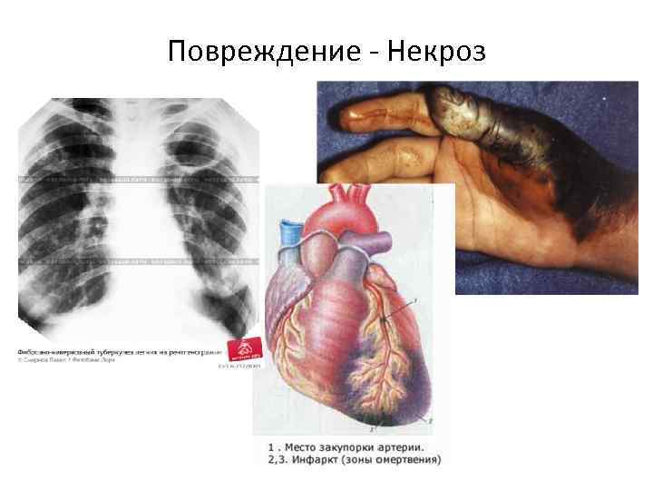 Повреждение - Некроз 