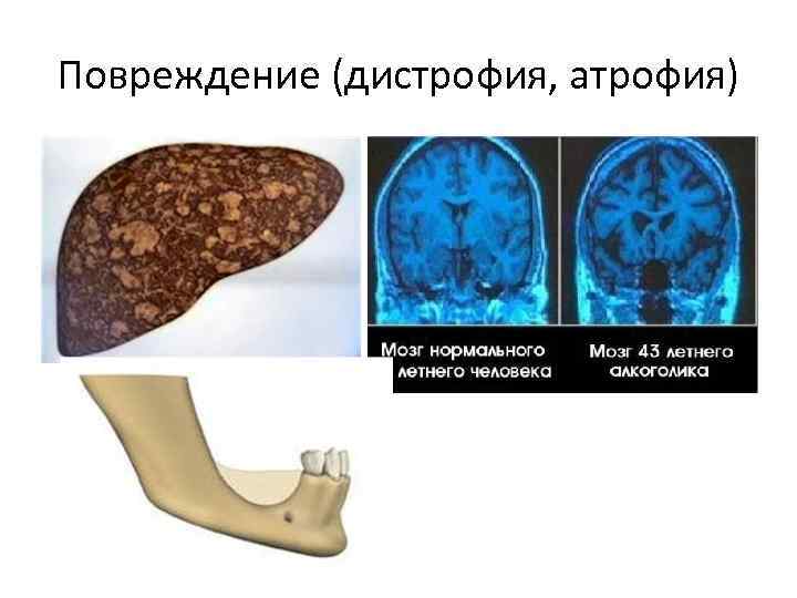 Повреждение (дистрофия, атрофия) 