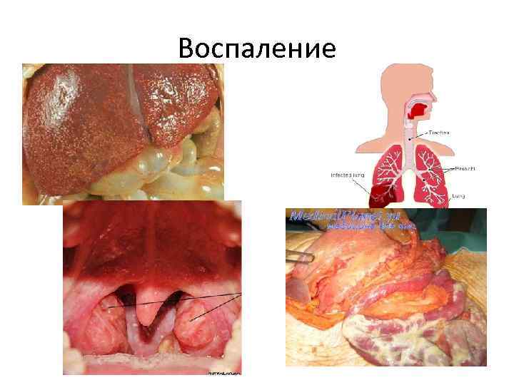 Воспаление 