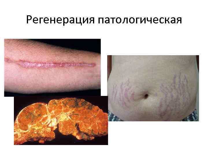 Регенерация патологическая 