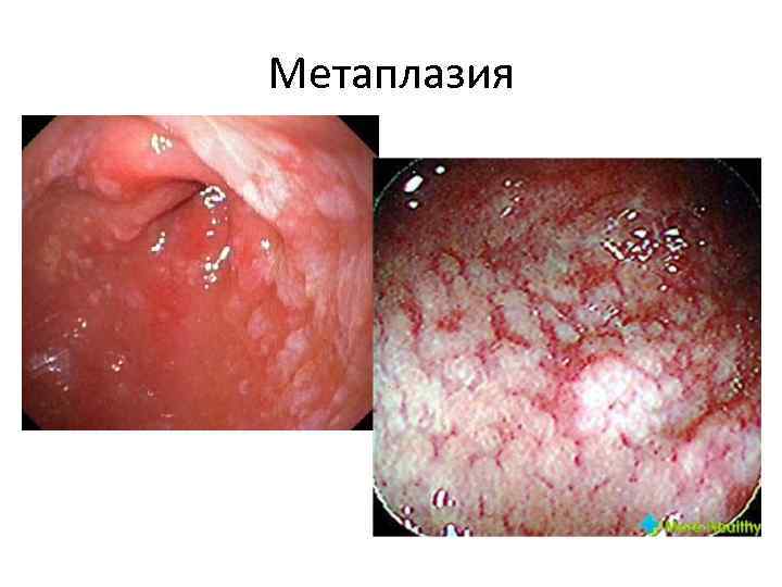 Метаплазия 