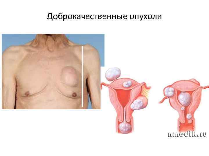 Доброкачественные опухоли 