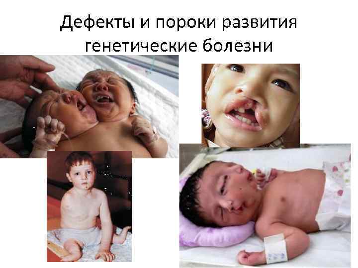 Дефекты и пороки развития генетические болезни 