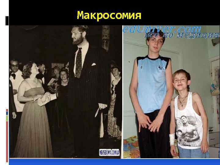 Макросомия 