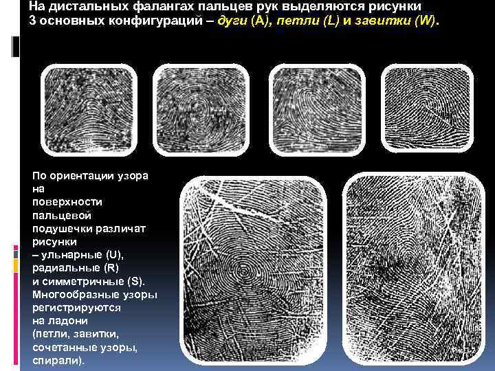 На дистальных фалангах пальцев рук выделяются рисунки 3 основных конфигураций – дуги (А), петли