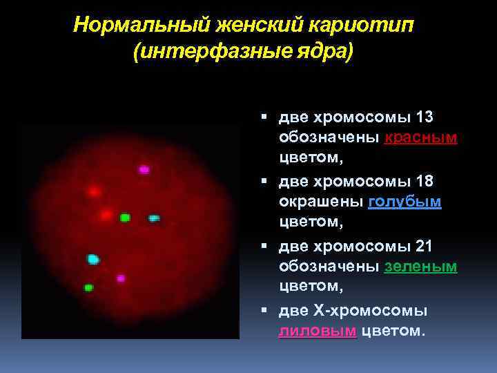 Нормальный женский кариотип (интерфазные ядра) две хромосомы 13 обозначены красным цветом, две хромосомы 18