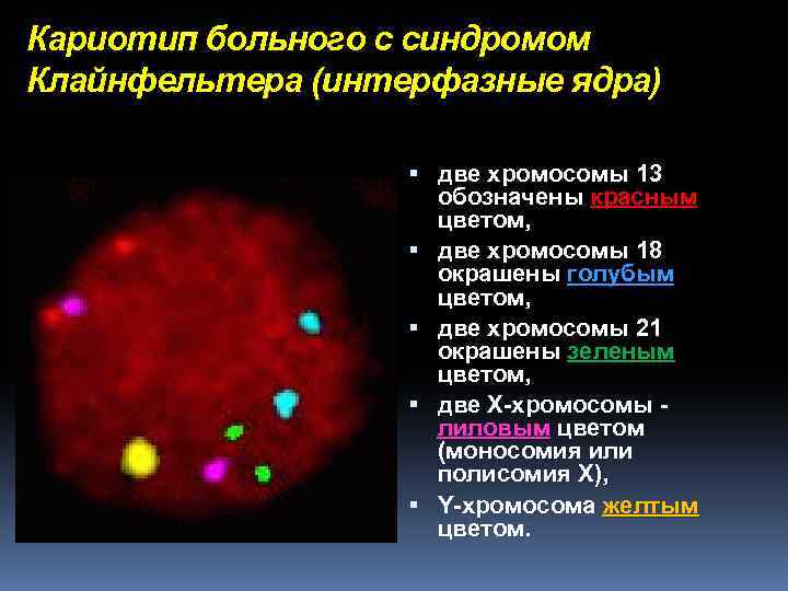 Кариотип больного с синдромом Клайнфельтера (интерфазные ядра) две хромосомы 13 обозначены красным цветом, две