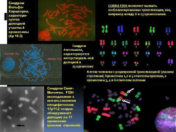 Синдром Вольфа. Хиршхорна, характеризуется делецией участка 4 хромосомы (4 p 16. 3) COBRA FISH