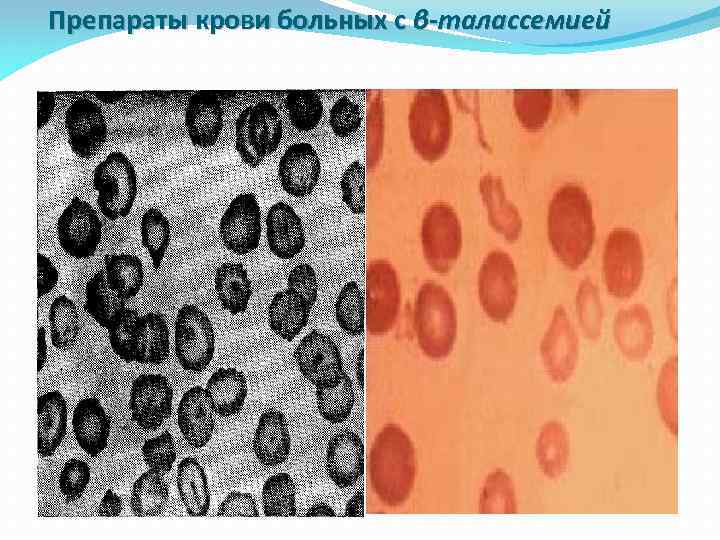 Препараты крови больных с β-талассемией 