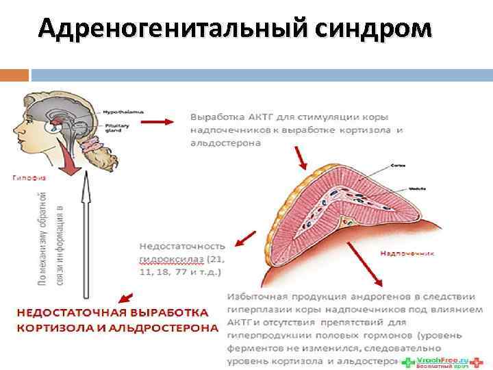 Адреногенитальный синдром 