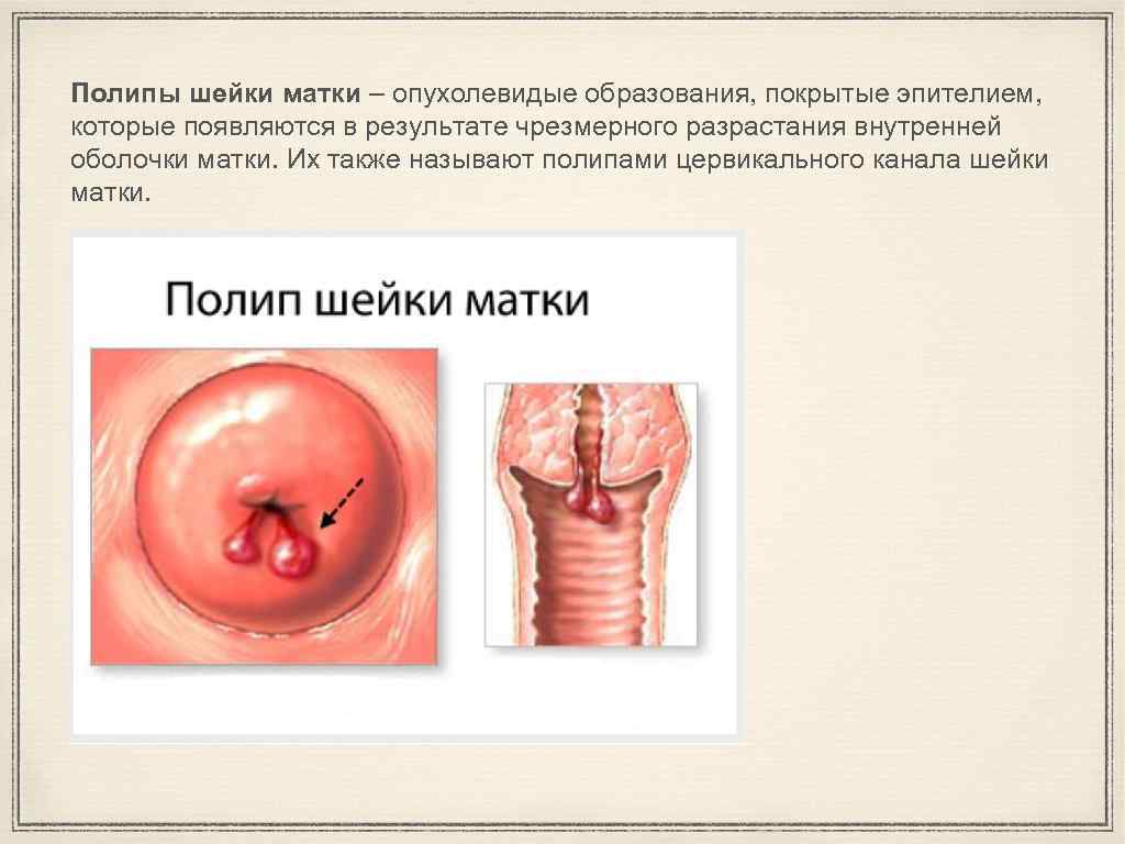 Полипы шейки матки – опухолевидые образования, покрытые эпителием, которые появляются в результате чрезмерного разрастания