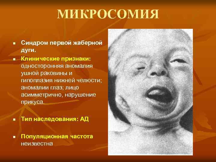 МИКРОСОМИЯ n n Синдром первой жаберной дуги. Клинические признаки: односторонняя аномалия ушной раковины и