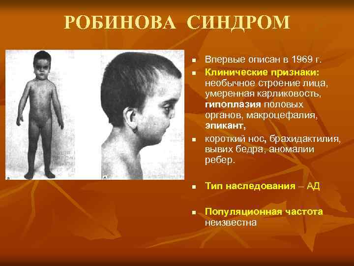 РОБИНОВА СИНДРОМ n n n Впервые описан в 1969 г. Клинические признаки: необычное строение