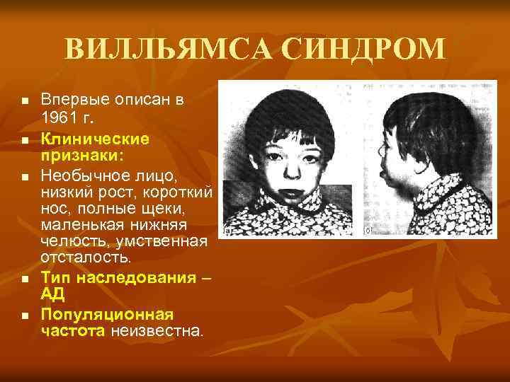 ВИЛЛЬЯМСА СИНДРОМ n n n Впервые описан в 1961 г. Клинические признаки: Необычное лицо,