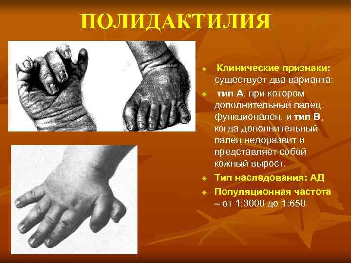 ПОЛИДАКТИЛИЯ u u Клинические признаки: существует два варианта: тип А, при котором дополнительный палец