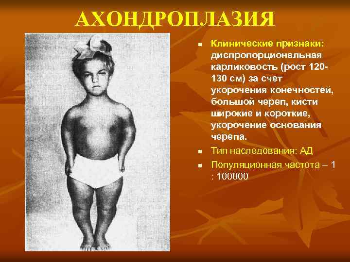 АХОНДРОПЛАЗИЯ n n n Клинические признаки: диспропорциональная карликовость (рост 120130 см) за счет укорочения